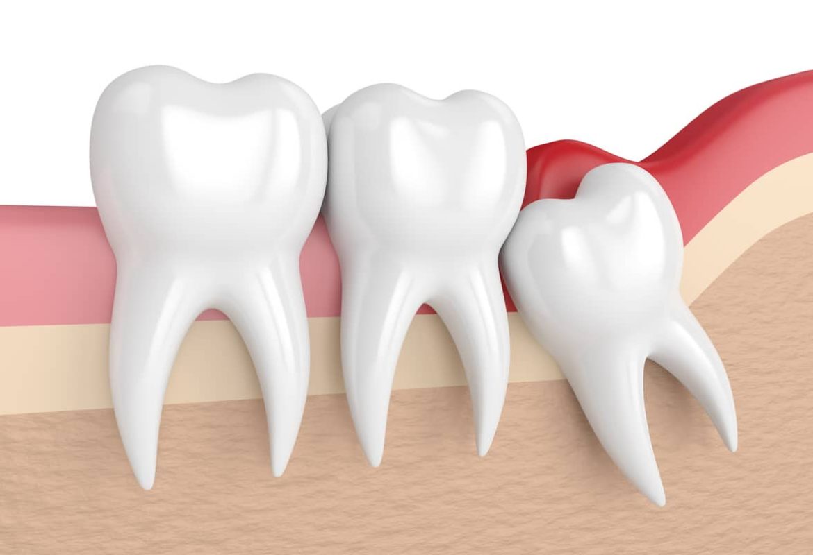 Everything you need to know about wisdom tooth extraction singapore